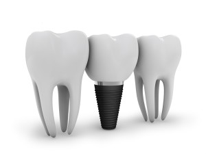 Our Cherry Hill, NJ area patients know that dental implants provide a much more comfortable restoration than that offered by dentures. 