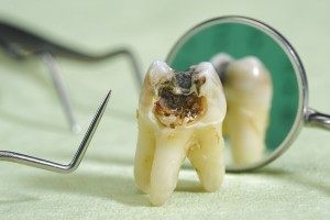 Our Cherry Hill, NJ area patients know the consequences of ignoring missing teeth.