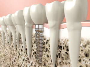 Our Cherry Hill, NJ area patients know that the dental implant process can leave them with beautiful replacement teeth.