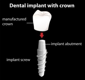 Our Cherry Hill and Camden County, NJ area patients know that each piece of a dental implant works together to provide the best possible replacement teeth. 