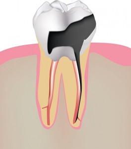 Our Cherry Hill and Camden County, NJ area patients know that missing teeth caused by tooth decay can be restored using dental implants.